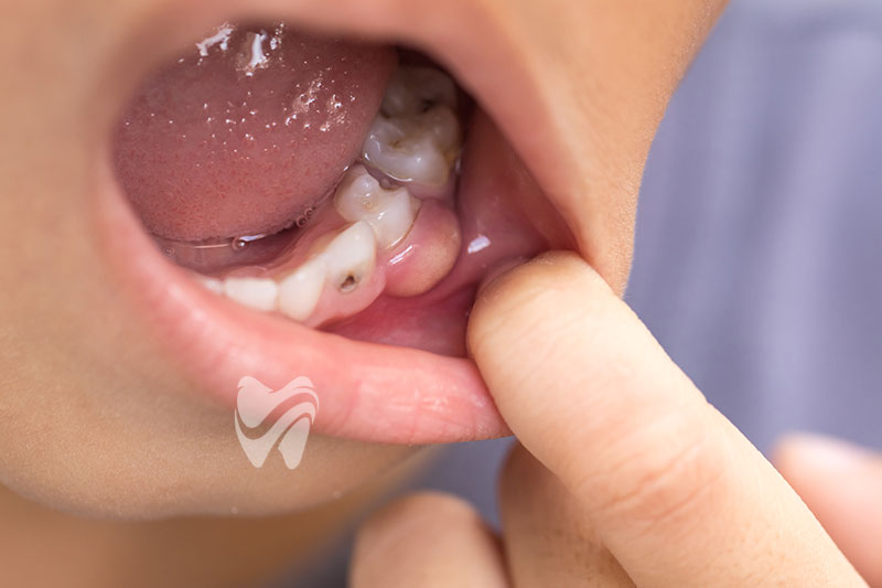 Süt Dişlerindeki Çürükler Tedavi Edilmeli mi?